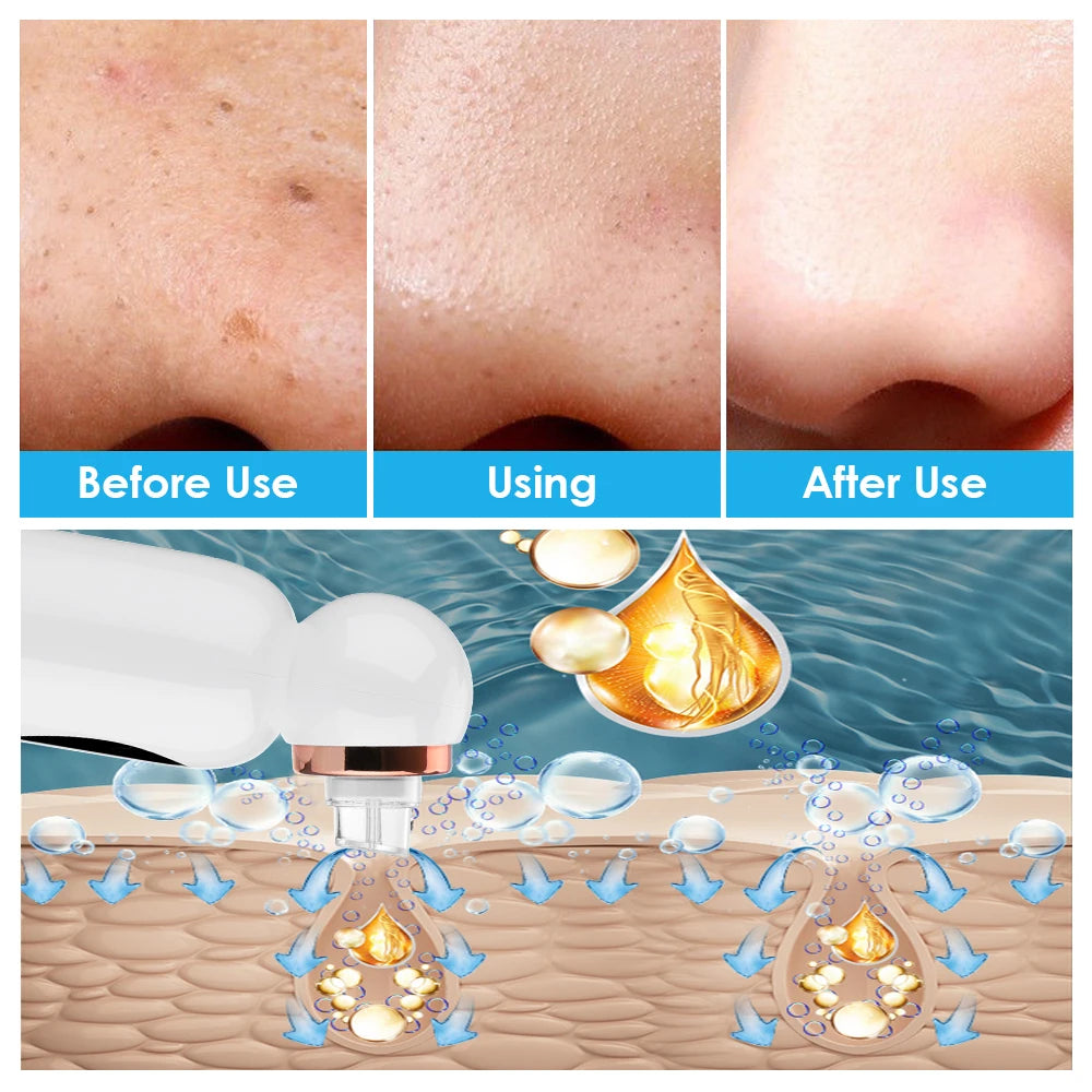 Blackhead Remover with Suction Technology