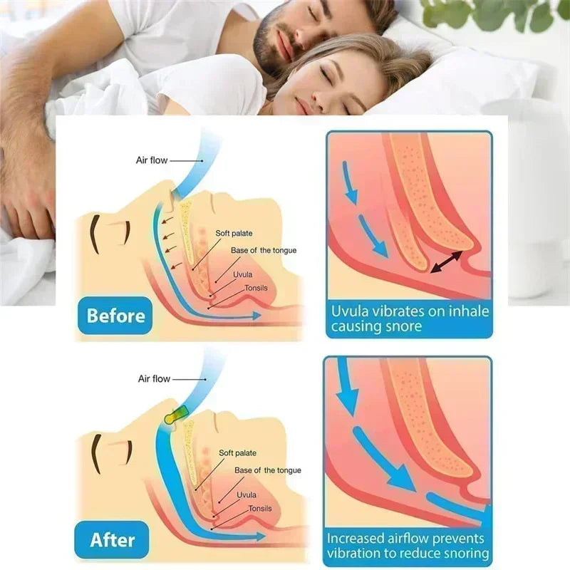 Anti-Snoring Corrector Snore Prevention Gadget